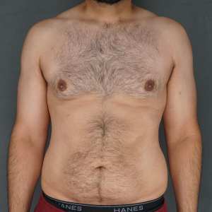 Middle-aged man gynecomastia correction invisible scar liposuction before and after – Plastic Surgery of New York post op – post op front view