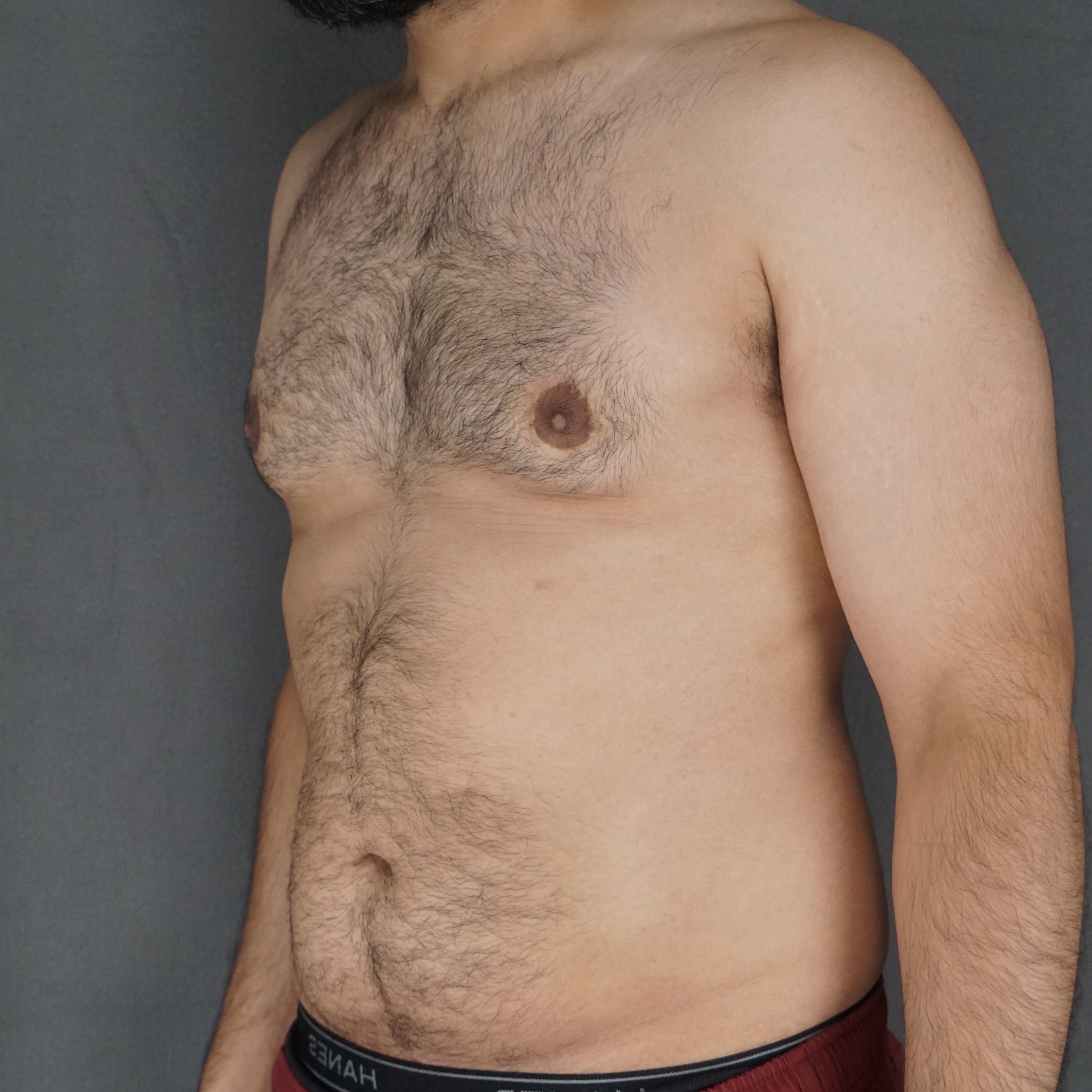 Middle-aged man gynecomastia correction invisible scar liposuction before and after – Plastic Surgery of New York post op – post op oblique view