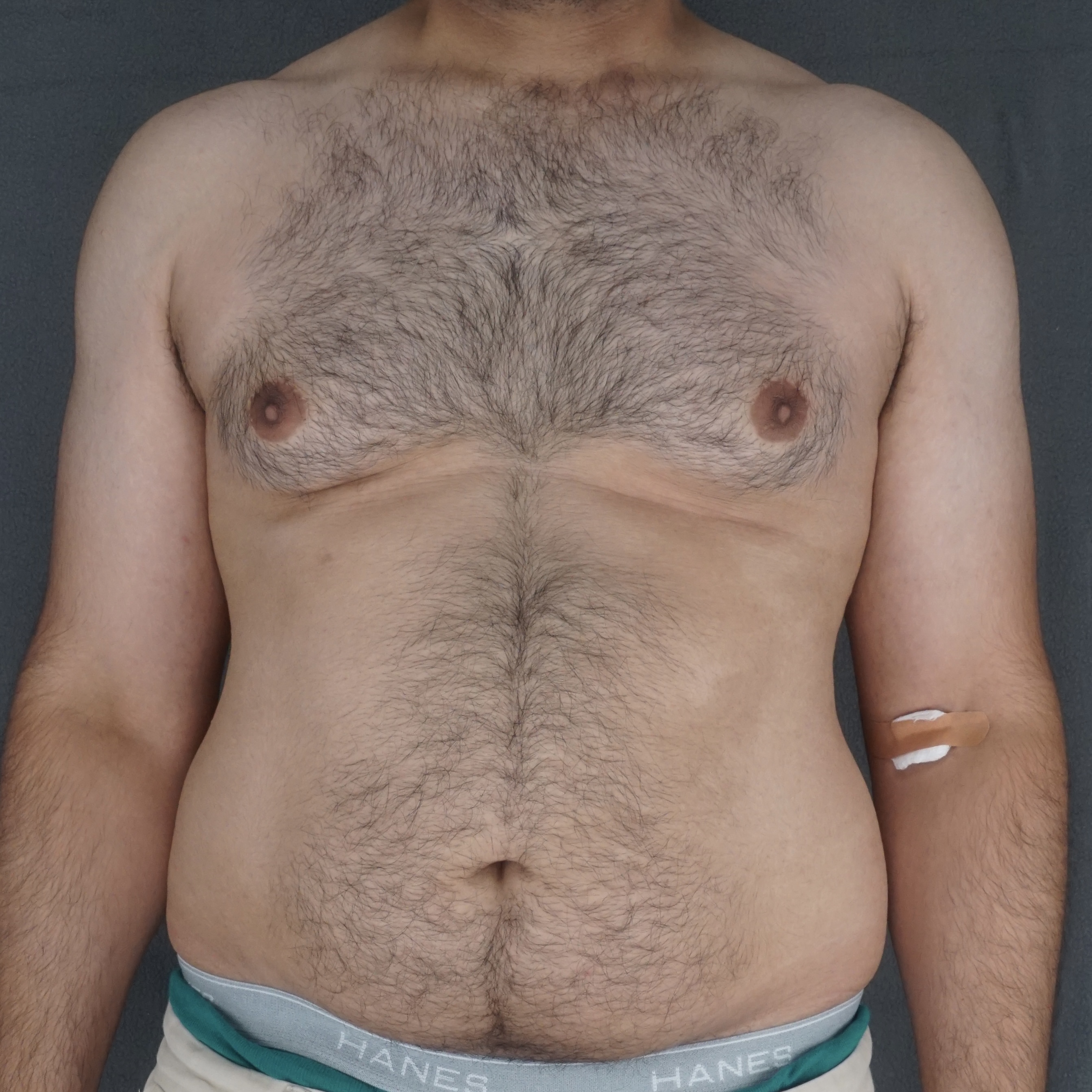 Correction de gynécomastie chez l'homme d'âge mûr liposuccion avec cicatrice invisible avant et après – Chirurgie plastique de New York