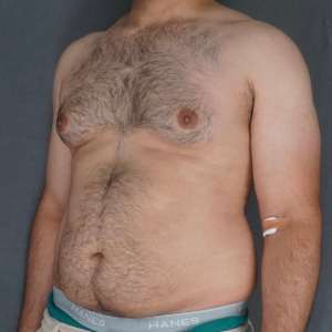 Middle-aged man gynecomastia correction invisible scar liposuction before and after – Plastic Surgery of New York preop