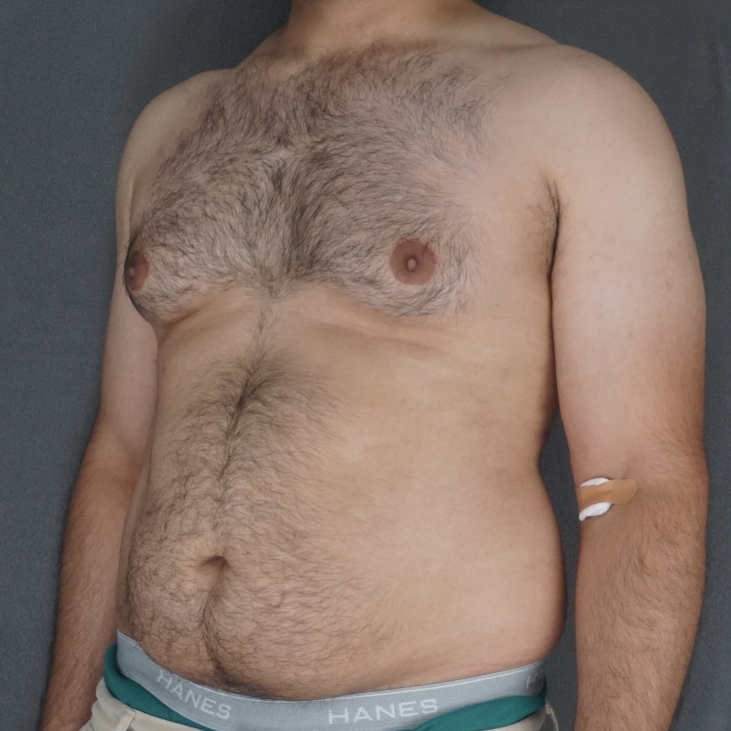 Correction de gynécomastie chez l'homme d'âge mûr, liposuccion cicatrice invisible avant et après – Chirurgie Plastique de New York, préopératoire