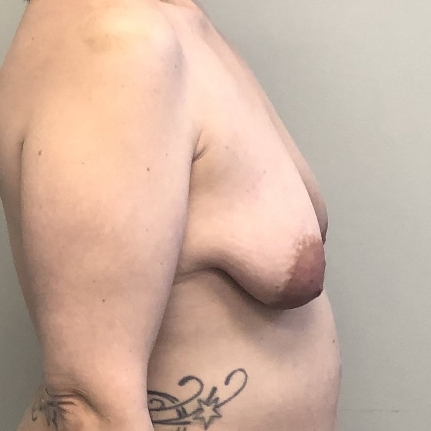 Lateral preoperative view of a middle-aged woman with significant breast, ptosis preoperative for breast augmentation and breast lift mastopexy