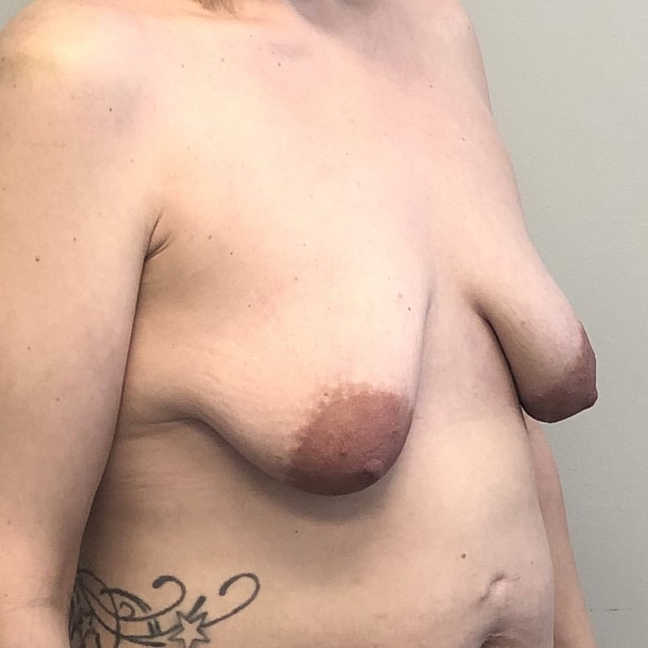 Oblique view preoperative view of a middle-aged woman with significant breast, ptosis preoperative for breast augmentation and breast lift mastopexy
