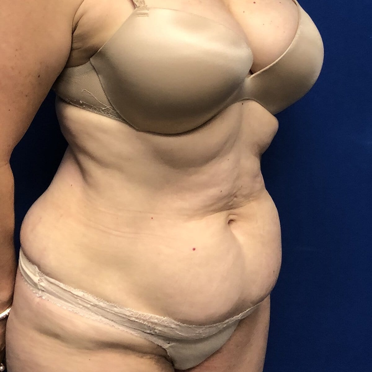 Close oblique view of older woman's abdomen with excess skin before abdominoplasty tummy tuck, Plastic Surgery of New York