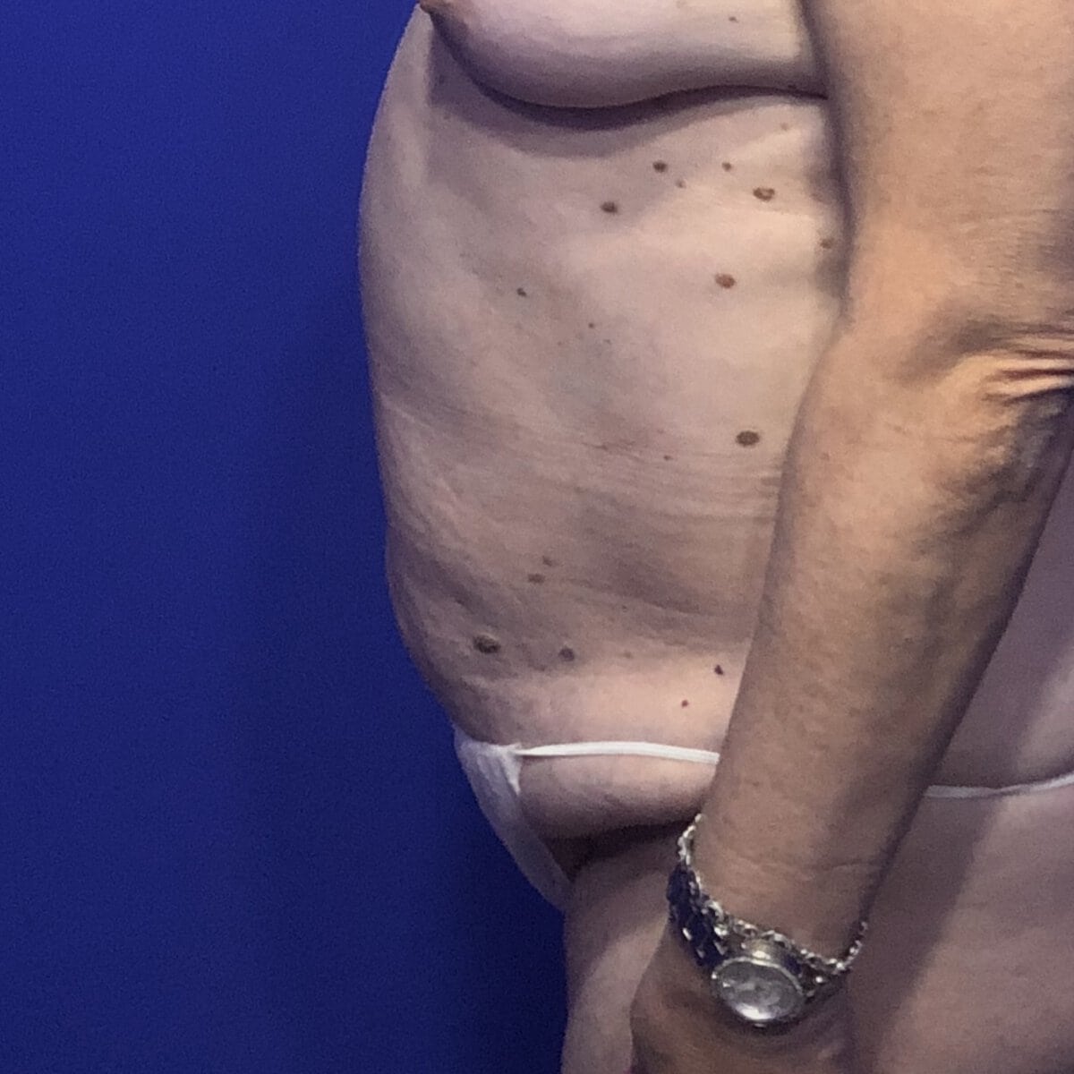 Older woman before abdominoplasty tummy tuck amazing result, Dr. Elkowitz Plastic Surgery of New York, great neck side view pre op