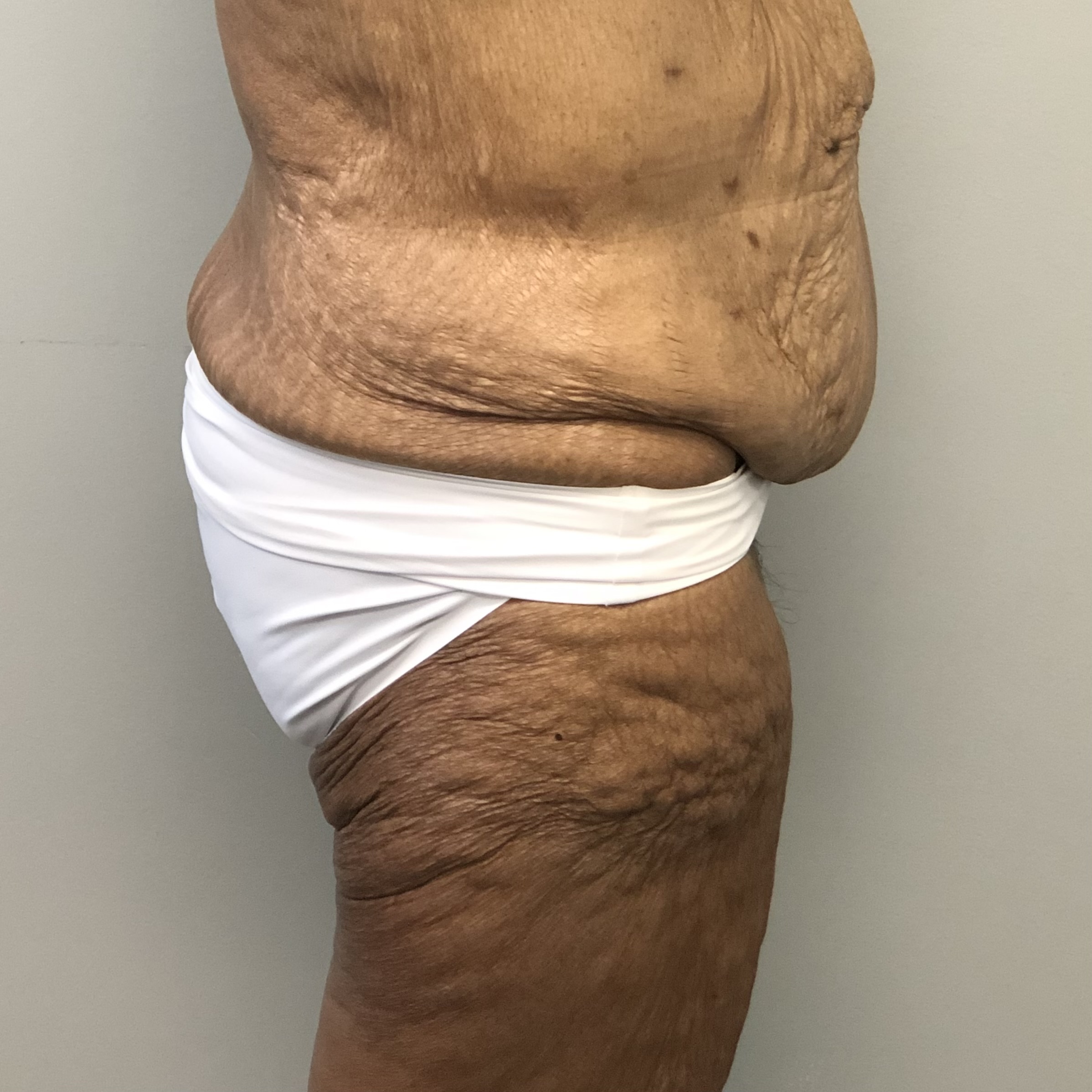 Thigh lift medial lateral weight loss before natural results - Dr. Elkowitz Great Neck NY