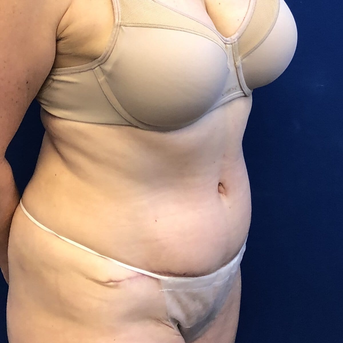 Middle-aged woman abdominoplasty tummy tuck after postoperative result natural results — Dr. Elkowitz, Plastic Surgery of New York