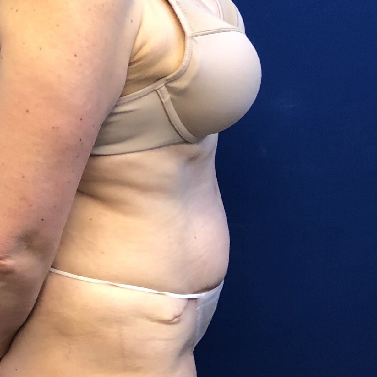 Middle-aged woman abdominoplasty tummy tuck after postoperative result natural results — Dr. Elkowitz, Plastic Surgery of New York lateral view – post op lateral
