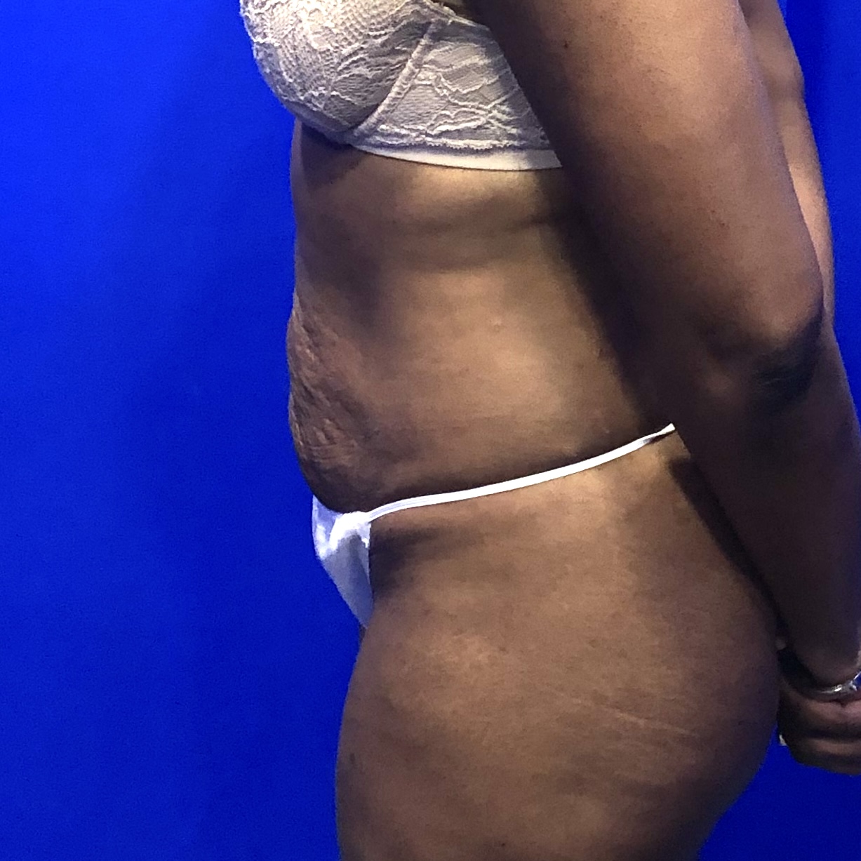 Tummy tuck abdominoplasty before natural results - Dr. Elkowitz Great Neck NY