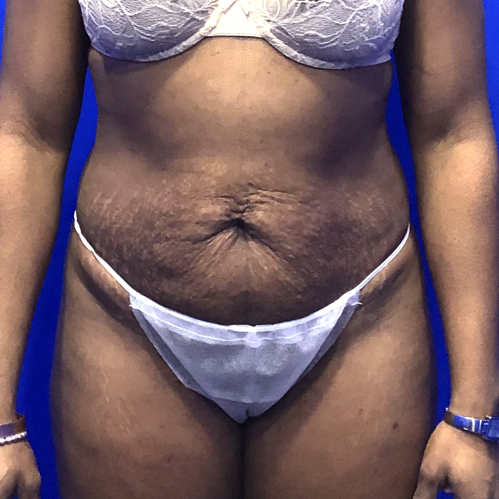 Tummy tuck abdominoplasty before natural results - Dr. Elkowitz Great Neck NY