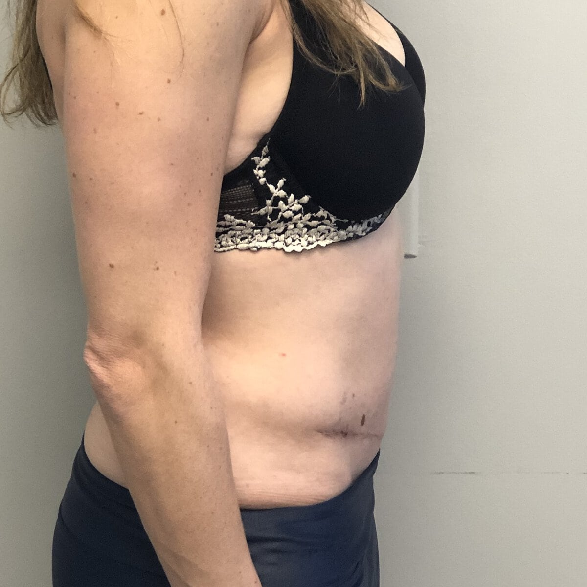 Side view of woman's abdomen after abdominoplasty tummy tuck showing flatter contour, Plastic Surgery of New York
