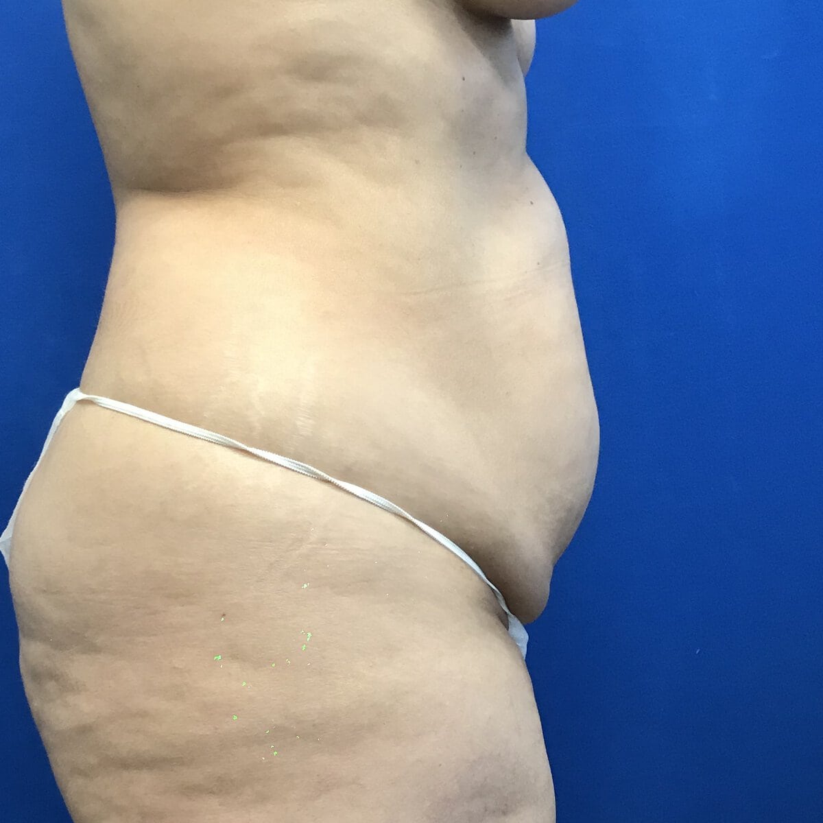 Close side view of woman's abdomen with excess skin before abdominoplasty tummy tuck, Plastic Surgery of New York