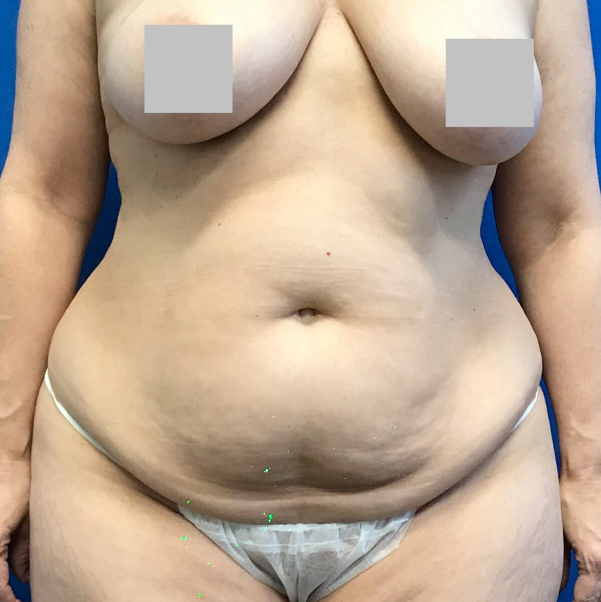 Front view of woman's abdomen with excess skin before abdominoplasty tummy tuck, Plastic Surgery of New York