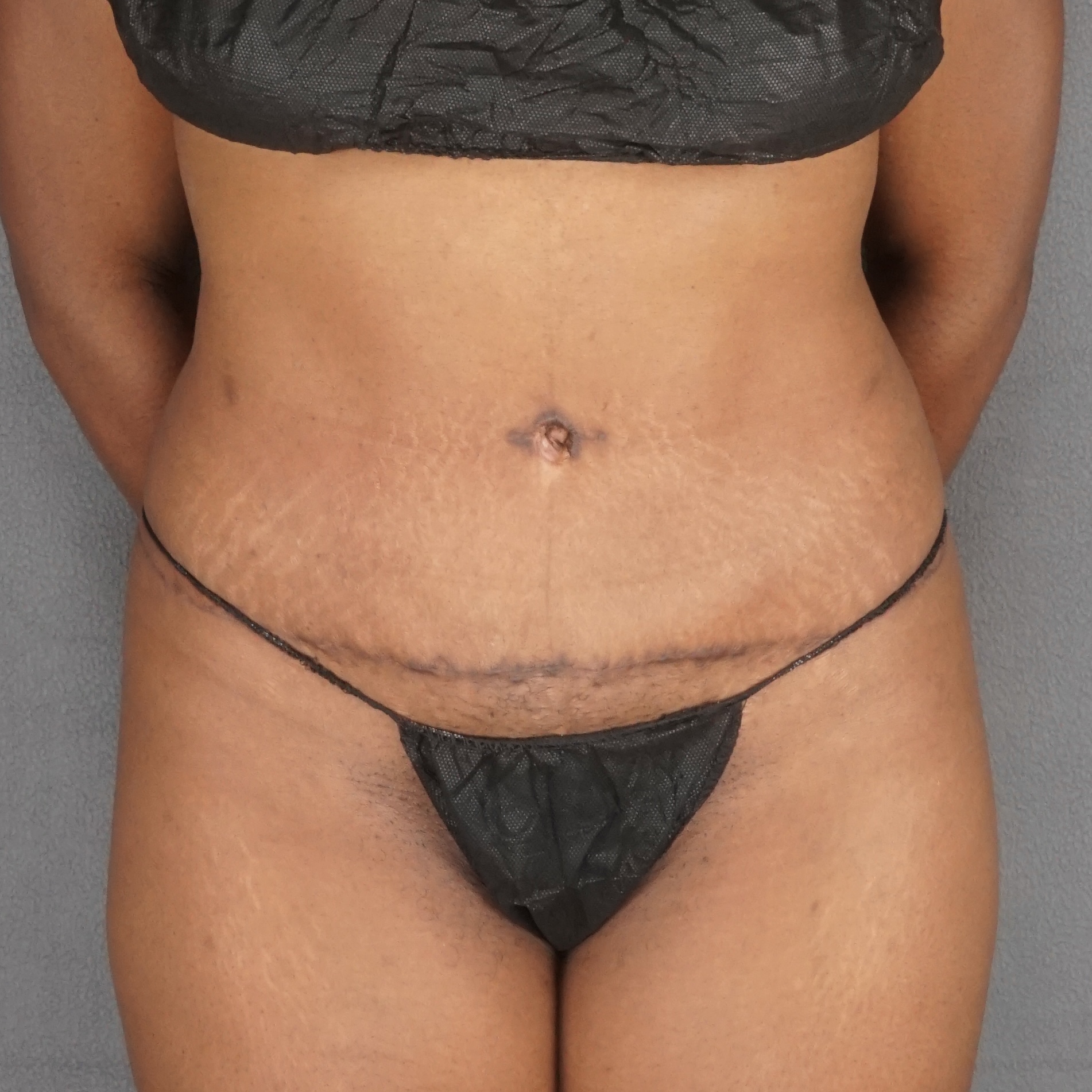 Woman abdomen after abdominoplasty front view natural results - Dr. Elkowitz Great Neck NY
