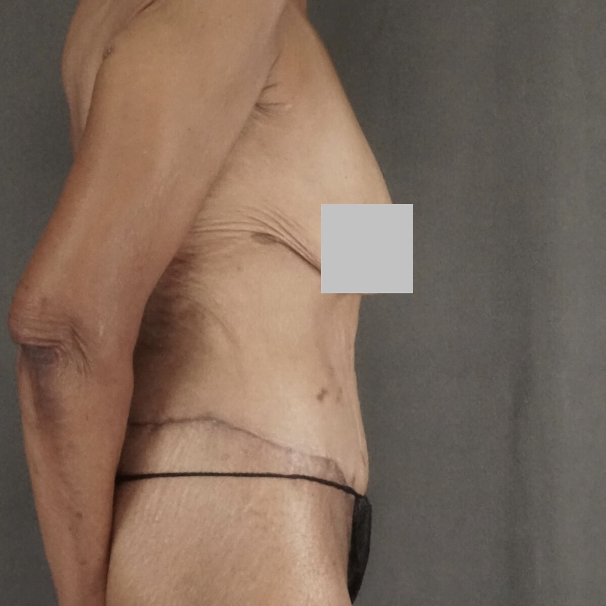 Side view of woman's abdomen with surgical markings before abdominoplasty, visible thigh skin laxity, second view, Plastic Surgery of New York