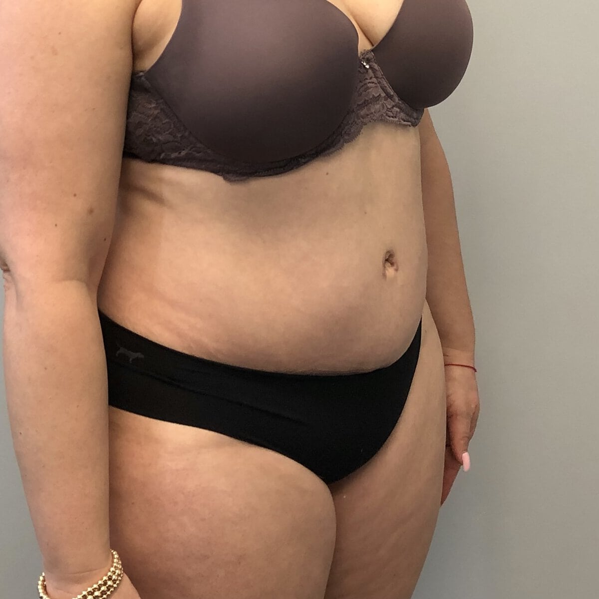 tummy tuck abdominoplasty before and after – post op oblique