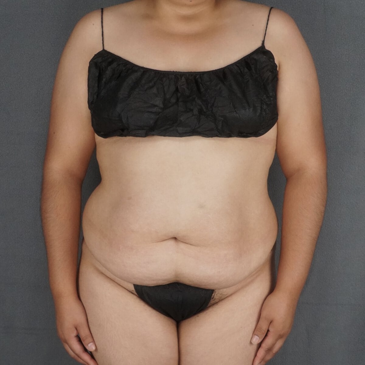 tummy tuck abdominoplasty before and after – pre op front significant abdominal muscle laxity