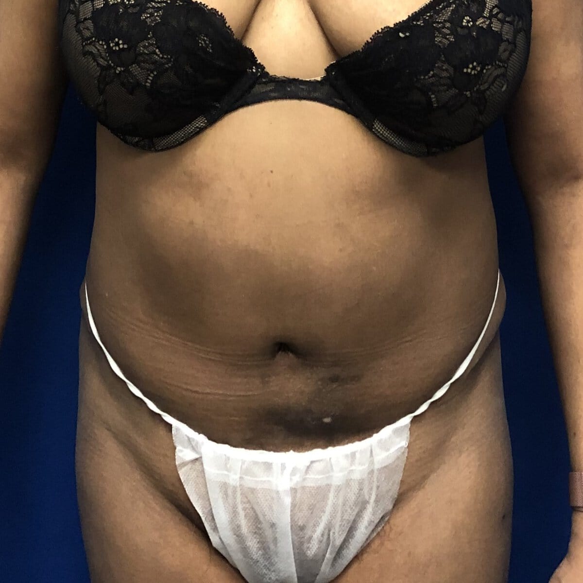 tummy tuck abdominoplasty before and after – post op oblique significant abdominal muscle laxity diastasis and extra skin
