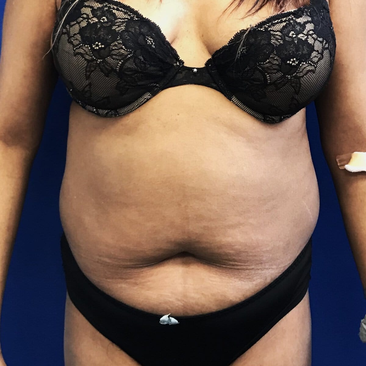 tummy tuck abdominoplasty before and after – pre op front significant abdominal muscle laxity diastasis and extra skin