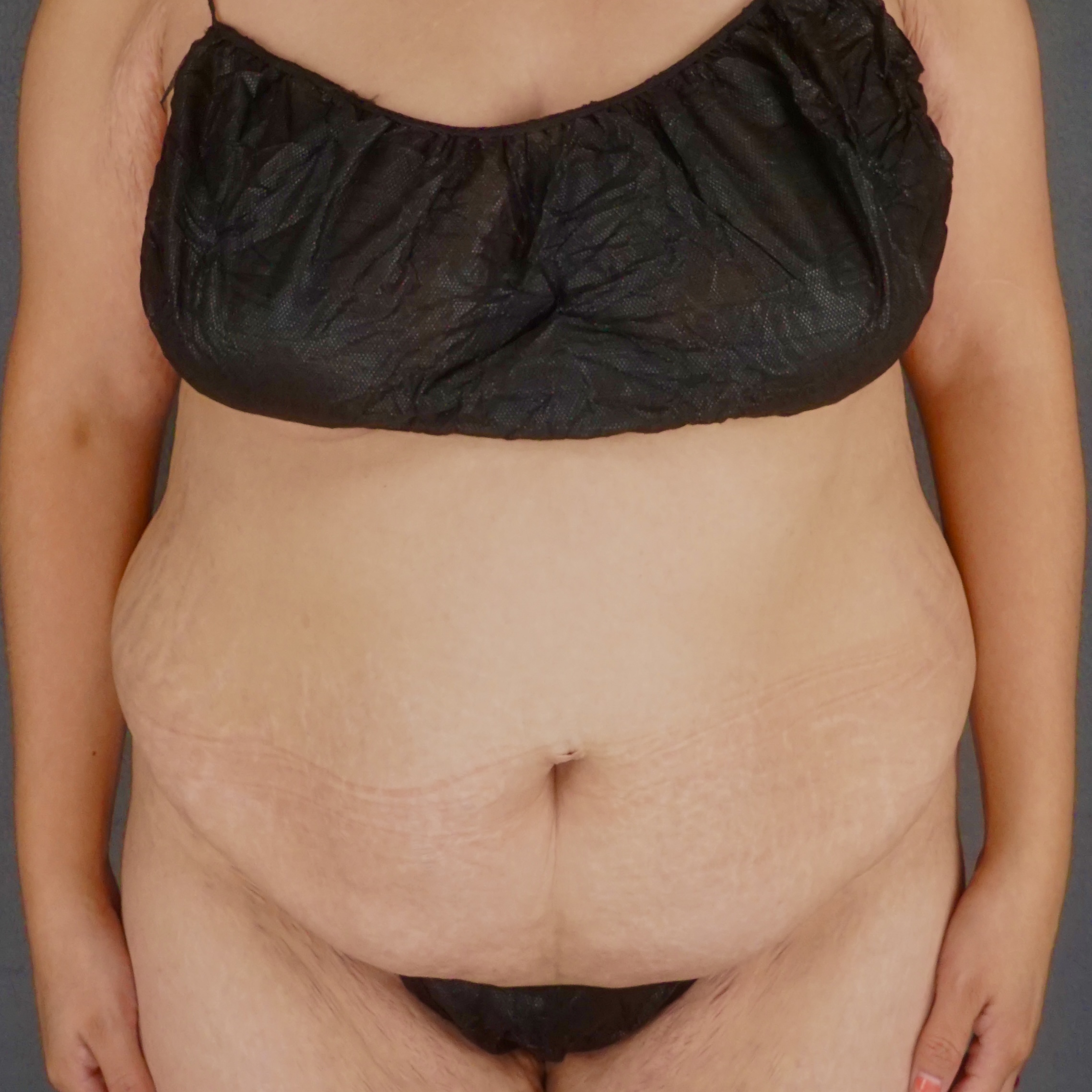 Woman before body contouring breast abdomen results - Dr. Elkowitz Great Neck NY