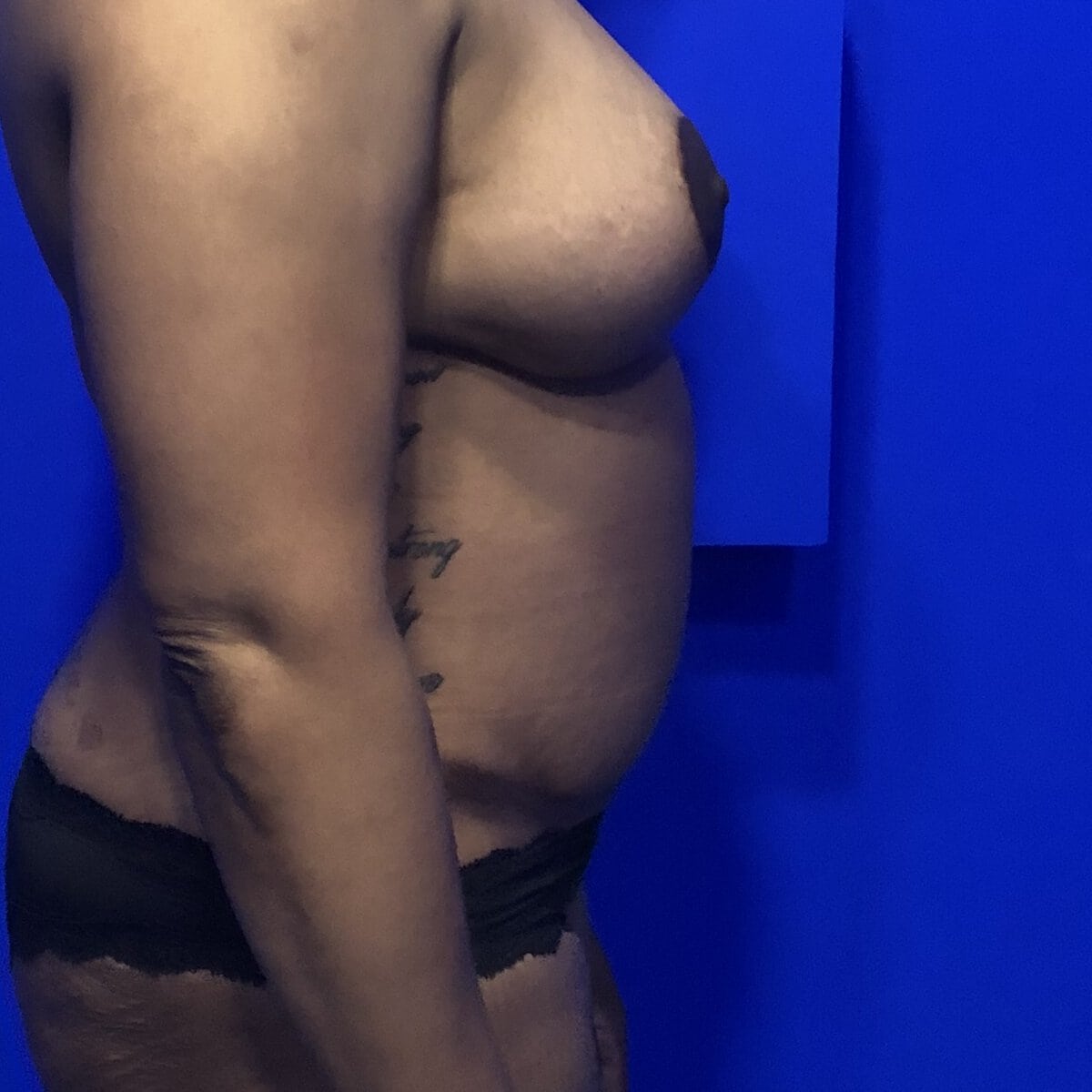 Side view consultation photo of woman's torso for breast and abdominal contouring evaluation, second patient, Plastic Surgery of New York