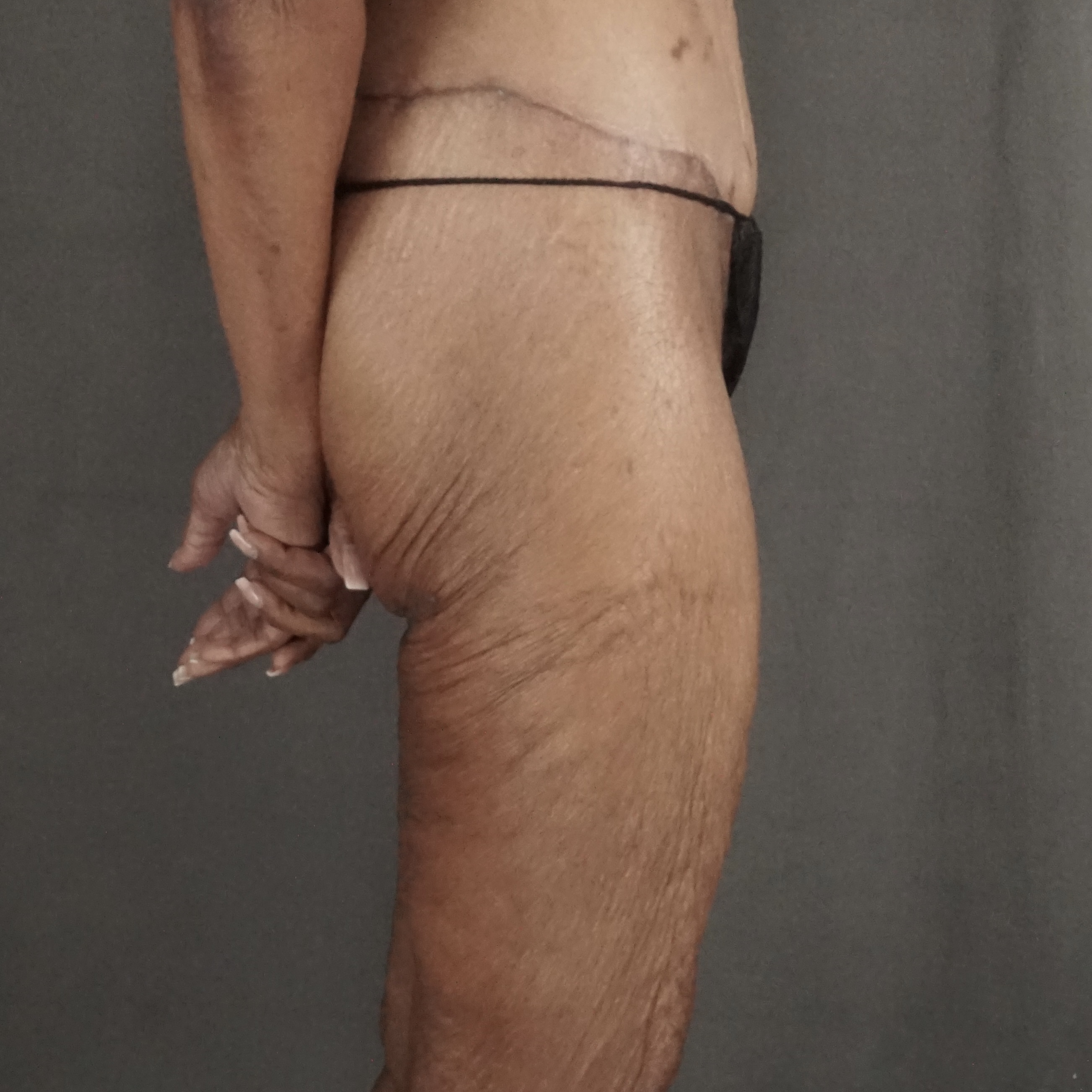 Woman thigh skin laxity after thigh lift close side view natural results - Dr. Elkowitz Great Neck NY