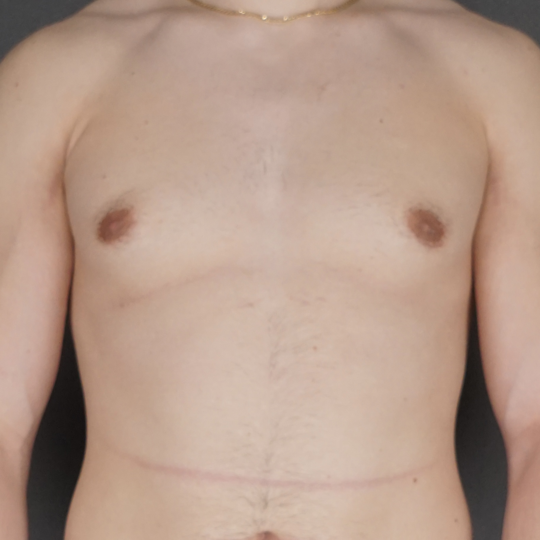 Jeune homme correction gynécomastie cicatrice invisible liposuccion excellent résultat – Chirurgie Plastique de New York avant