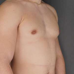 oung man gynecomastia correction invisible scar liposuction great result – Plastic Surgery of New York pre op before after lateral