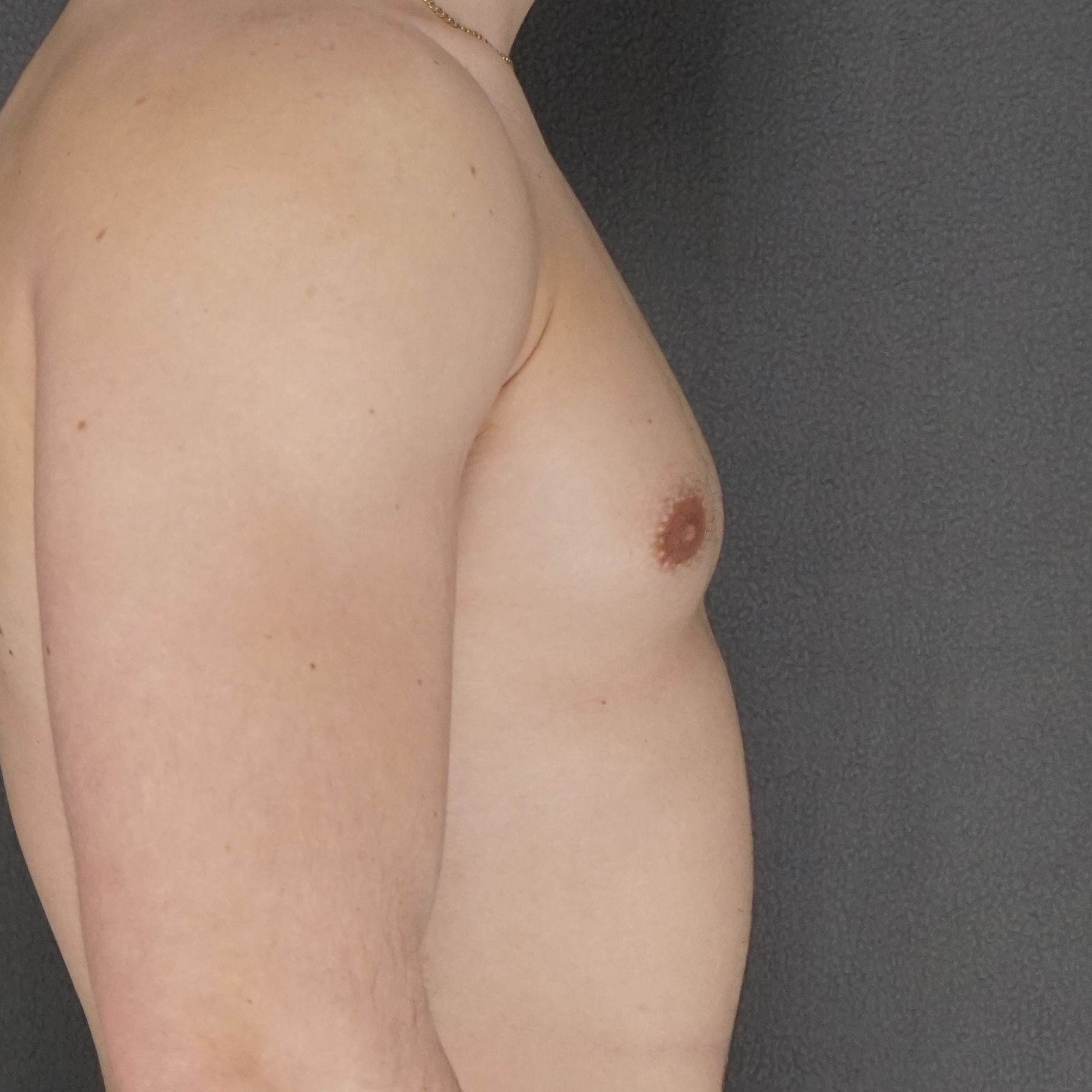 Jeune homme correction gynécomastie cicatrice invisible liposuccion excellent résultat – Chirurgie plastique de New York préopératoire avant après côté