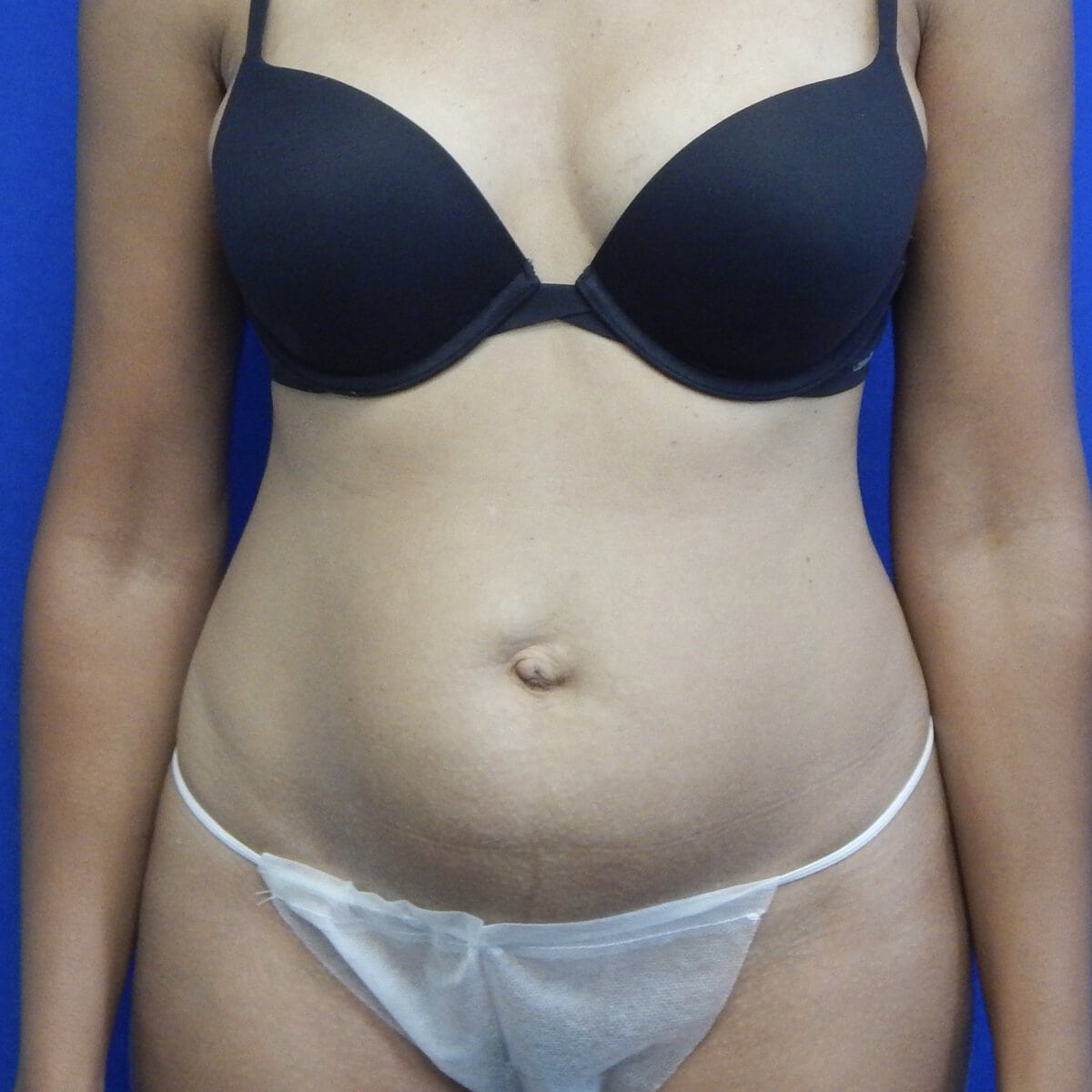 Young woman abdominoplasty tummy tuck before natural results — Dr. Elkowitz, Plastic Surgery of New York front view