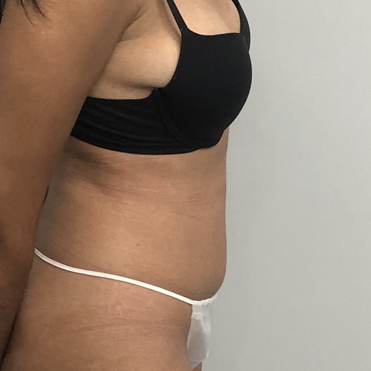 Young woman abdominoplasty tummy tuck before and after natural results — Dr. Elkowitz, Plastic Surgery of New York side view