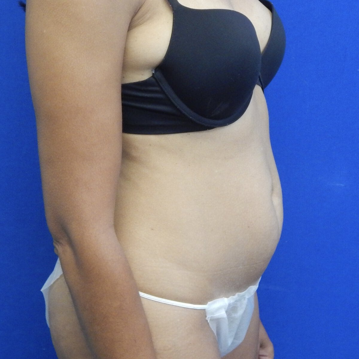 Young woman abdominoplasty tummy tuck before preoperative of oblique view natural results — Dr. Elkowitz, Plastic Surgery of New York side view