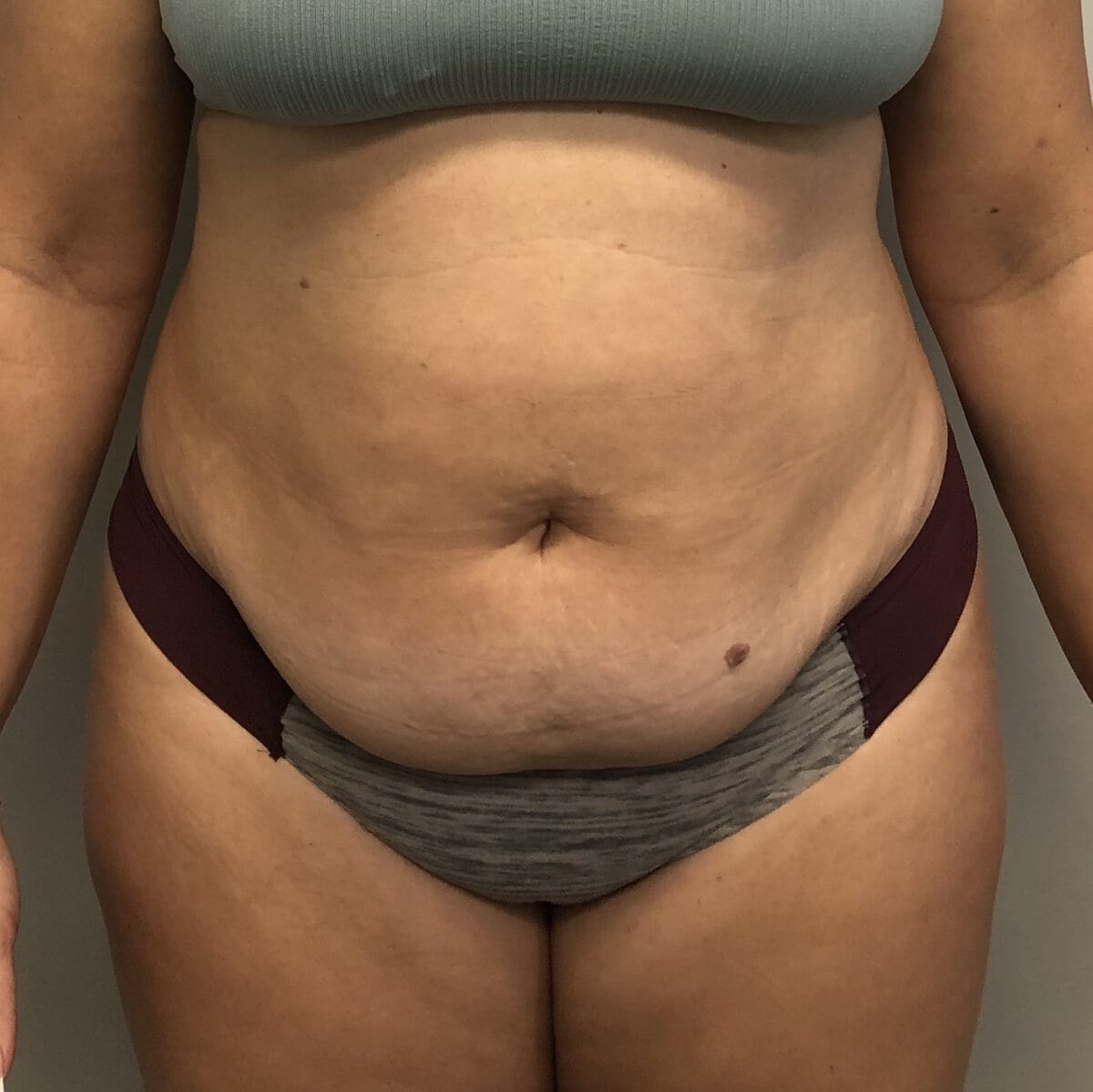 Young woman before cosmetic abdominoplasty skin excision Plastic Surgery, Surgery of New York, York, Dr., Elkowitz