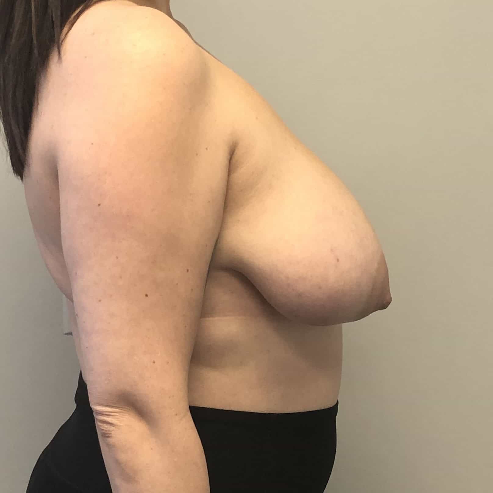 Young woman macromastia breast reduction before lateral view - Dr. Elkowitz Great Neck NY