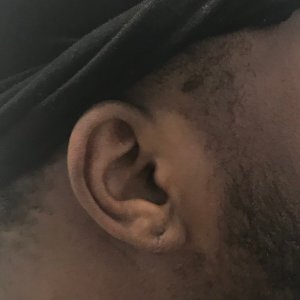 Close-up of African American man's earlobe after keloid removal surgery, different angle – Plastic Surgery of New York