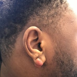 Close-up of African American man's earlobe keloid before removal surgery – Plastic Surgery of New York