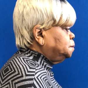 Blonde woman ear cleft repair result, side profile view – Plastic Surgery of New York