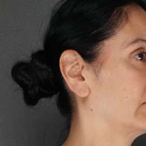 Extreme close-up of woman's elongated, split earlobe before reduction surgery – Plastic Surgery of New York