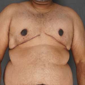 Post-op front view after large gynecomastia excision, flatter male chest contour - Plastic Surgery of New York