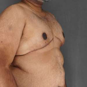 Post-op oblique view after large gynecomastia excision, healing incision line - Plastic Surgery of New York