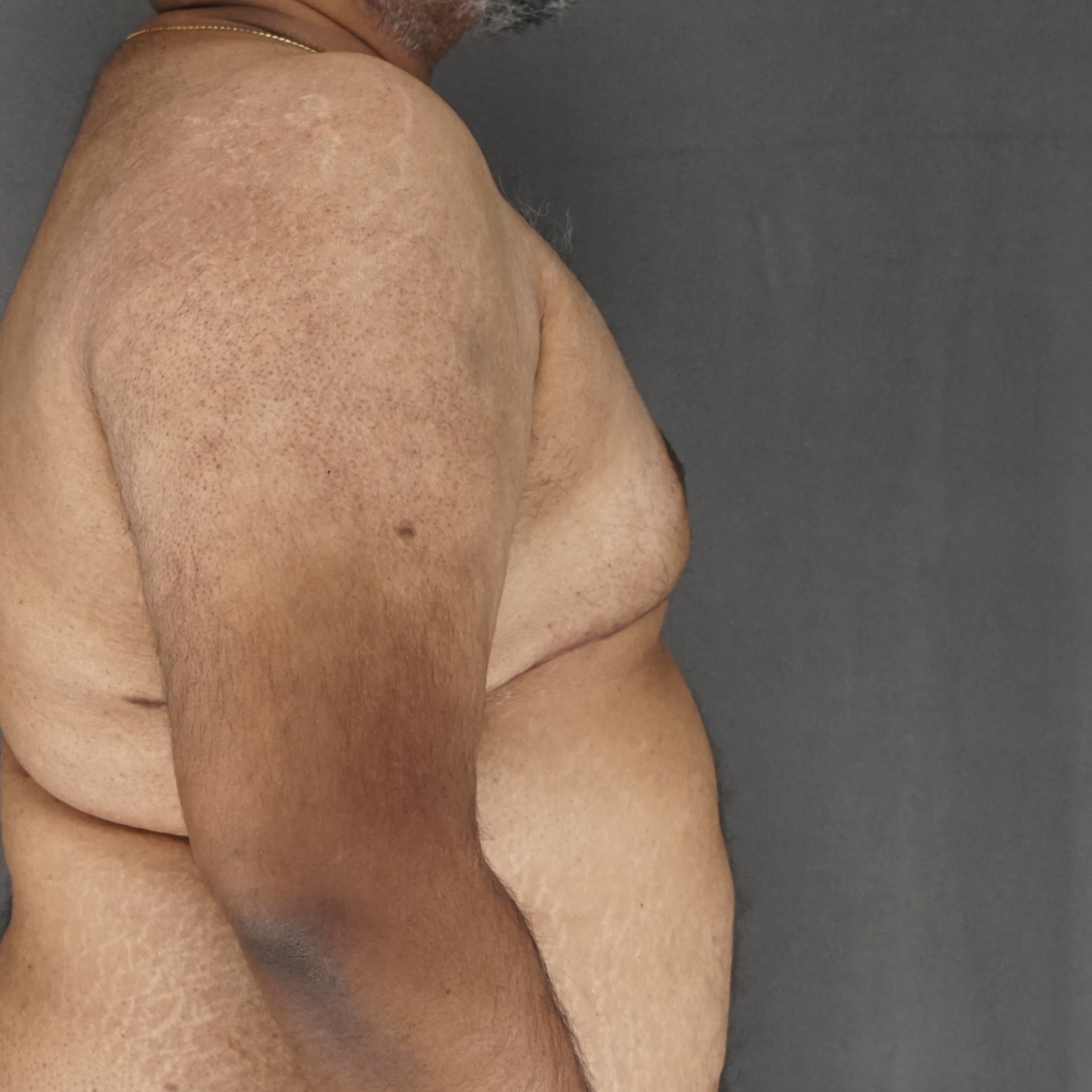 Vue latérale post-opératoire après exérèse d'une gynécomastie importante, contour de la poitrine plat et naturel - Chirurgie plastique de New York