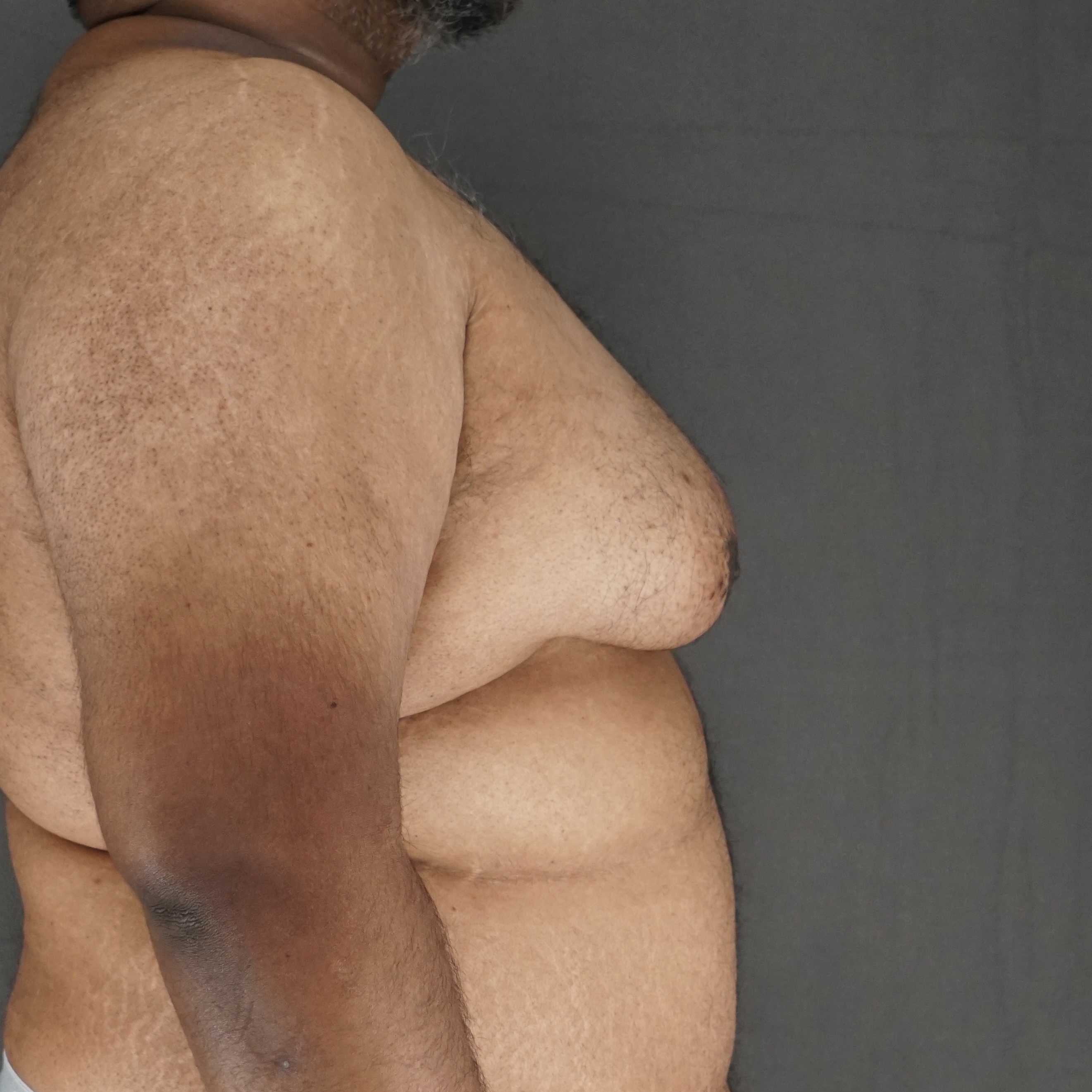 Vue de profil préopératoire avant l'excision d'une gynécomastie importante - Plastic Surgery of New York
