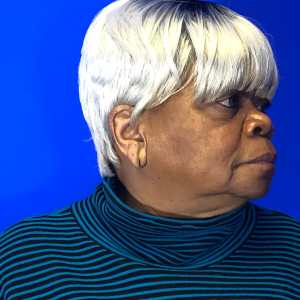 Older woman before cleft earlobe repair, side view – Plastic Surgery of New York