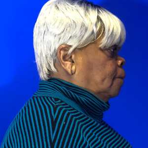 Older woman complete cleft earlobe repair natural results – Plastic Surgery of New York