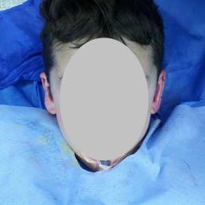 Front view of young boy's prominent ears before otoplasty surgery in the operating room – Plastic Surgery of New York