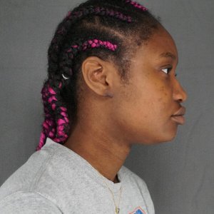 Young woman ear keloid removal before and after amazing results – Plastic Surgery of New York post op
