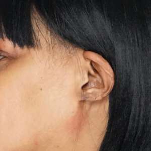 Young woman's cleft earlobe repair result shown from the side - Plastic Surgery of New York