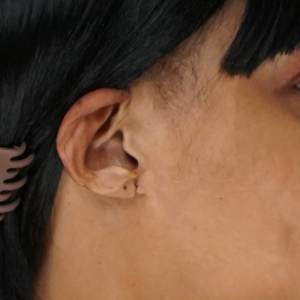 Cleft earlobe repair result shown in close-up, oblique angle - Plastic Surgery of New York