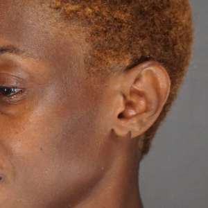 Close-up side view of cleft earlobe repair result - Plastic Surgery of New York