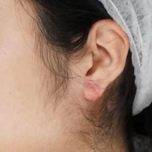 Pre-operative ear keloid photo, oblique view with surgical cap - Plastic Surgery of New York